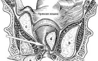 Чем и как лечить парапроктит – подкожный, хронический, гнойный