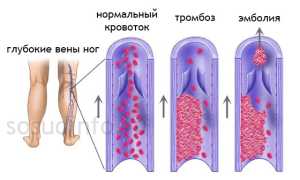 Венозный тромбоз сосудов ног: от первых признаков и профилактики до борьбы с болезнью