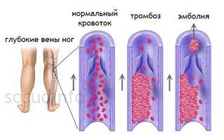 Венозный тромбоз сосудов ног: от первых признаков и профилактики до борьбы с болезнью