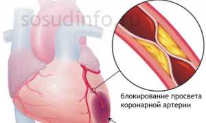 Предынфарктное состояние: что это, проявления, как выявить и предотвратить развитие