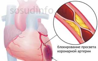 Предынфарктное состояние: что это, проявления, как выявить и предотвратить развитие