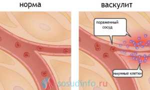 Синдром Кавасаки: причины, симптомы и проявления, чем опасен, терапия