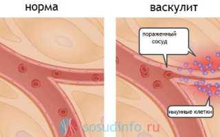 Синдром Кавасаки: причины, симптомы и проявления, чем опасен, терапия