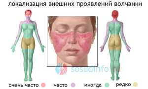 Системная красная волчанка: развитие, формы, проявления и течение, диагностика, лечение