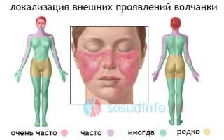 Системная красная волчанка: развитие, формы, проявления и течение, диагностика, лечение