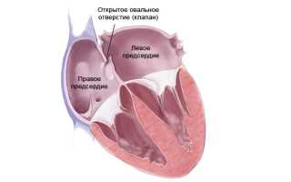 Открытое овальное окно (отверстие) в сердце: причины, закрытие, прогноз