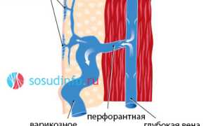 Ретикулярный варикоз: развитие, признаки, как лечить, профилактика усугубления