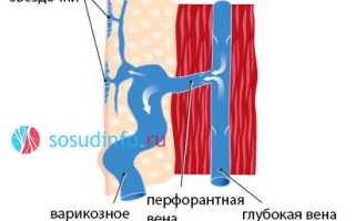 Ретикулярный варикоз: развитие, признаки, как лечить, профилактика усугубления