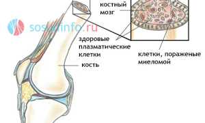 Миелома (плазмоцитома): причины, формы и стадии, клиника, выявление, современная терапия