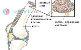 Миелома (плазмоцитома): причины, формы и стадии, клиника, выявление, современная терапия
