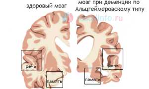 Деменция (слабоумие): причины, как развивается, виды, проявления, диагностика, лечение