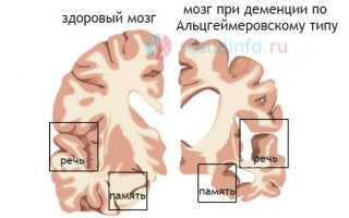 Деменция (слабоумие): причины, как развивается, виды, проявления, диагностика, лечение