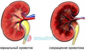 Почечная гипертензия: механизм развития и особенности, проявления, диагностика, лечение