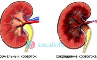 Почечная гипертензия: механизм развития и особенности, проявления, диагностика, лечение