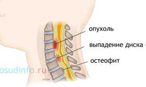 Миелопатия: цервикальная, компрессионная, вертеброгенная, дегенеративная