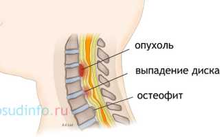 Миелопатия: цервикальная, компрессионная, вертеброгенная, дегенеративная