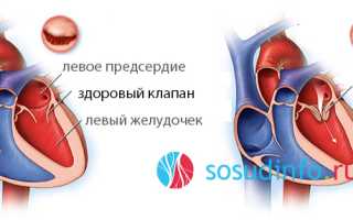 Митральная недостаточность: развитие, симптомы, диагностика, как лечить, прогноз