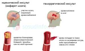 Стволовой инсульт: виды (ишемический, геморрагический), причины, симптомы, лечение, прогноз