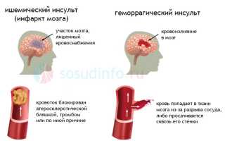 Стволовой инсульт: виды (ишемический, геморрагический), причины, симптомы, лечение, прогноз