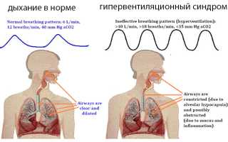 Гипокапния: механизм развития, проявления, диагностика, лечение