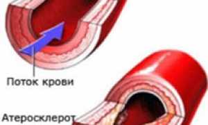 Профилактика атеросклероза: правильное питание и образ жизни