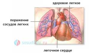 Гипертрофия правого желудочка: причины, признаки, диагностика, как лечить, прогноз