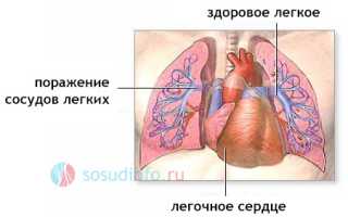 Гипертрофия правого желудочка: причины, признаки, диагностика, как лечить, прогноз