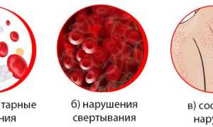 Геморрагический диатез: причины, классификация, симптомы, диагностика, лечение