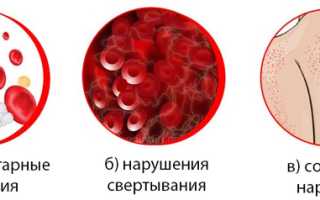 Геморрагический диатез: причины, классификация, симптомы, диагностика, лечение