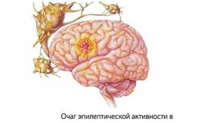 Эпилепсия: развитие, формы, причины, признаки и проявления, первая помощь, как лечить