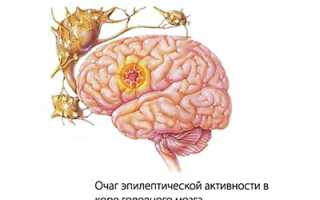 Эпилепсия: развитие, формы, причины, признаки и проявления, первая помощь, как лечить