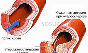 Витамины для укрепления сосудов: какие нужны и где их искать?