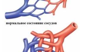Болезнь Рандю-Ослера: причины, симптомы, лечение, прогноз