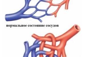 Болезнь Рандю-Ослера: причины, симптомы, лечение, прогноз