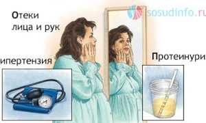 Гестоз: понятие, как проявляется, степени и их клиника, чем опасен, диагностика, лечение