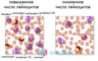 Лейкопения: типы, признаки, проявления, врачебное и народное лечение, опасность болезни