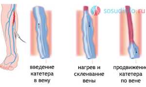 Радиочастотная облитерация вен при варикозе: показания, процедура, результат, сравнение с “лазером”