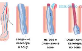 Радиочастотная облитерация вен при варикозе: показания, процедура, результат, сравнение с “лазером”