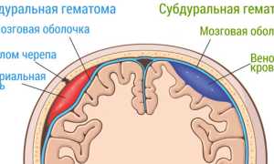 Гематома головного мозга: виды, причины, симптомы, лечение, последствия