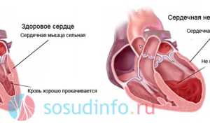 Сердечная недостаточность: признаки, формы, лечение, помощь при обострении