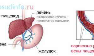 Варикоз пищевода: как развивается и факторы риска, симптомы, осложнения, лечение