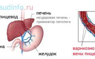 Варикоз пищевода: как развивается и факторы риска, симптомы, осложнения, лечение