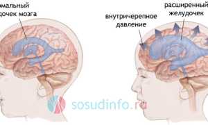 Гидроцефалия (“водянка мозга”): как развивается, формы, проявления, лечение, последствия