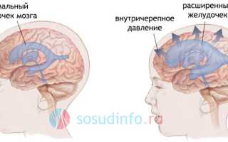 Гидроцефалия (“водянка мозга”): как развивается, формы, проявления, лечение, последствия