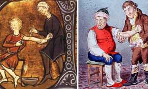 Кровопускание: от средневековья к современности, техники, имеет ли смысл и когда реально показано?