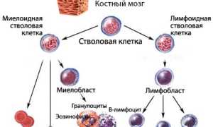 Миелодиспластический синдром: классификация, развитие, лечение, рекомендации, прогноз