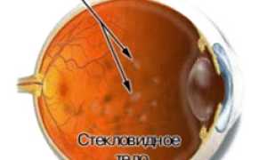 Мушки перед глазами: причины, лечение, что делать, связь с болезнями