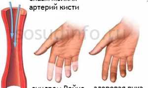 Болезнь Рейно: как возникает, проявления и течение, принципы лечения