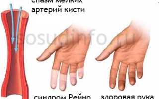 Болезнь Рейно: как возникает, проявления и течение, принципы лечения