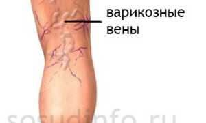 Выступающие сосуды: всегда ли это варикоз и стоит ли волноваться?